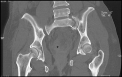 Sacral Fracture - CTisus CT Scan