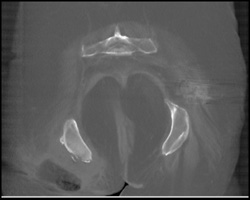Subtle Ischial Avulsion Fracture on Right - CTisus CT Scan