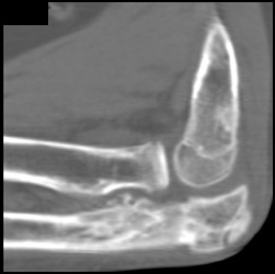 Healing Ulna- Fracture - CTisus CT Scan