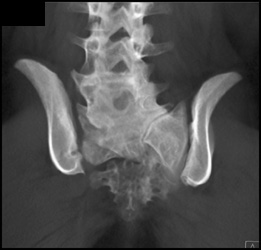 Deformity of Pelvis With Sacral Agenesis - CTisus CT Scan
