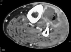 Abscess - CTisus CT Scan