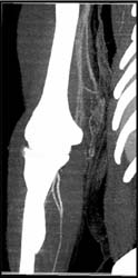 Abscess - CTisus CT Scan