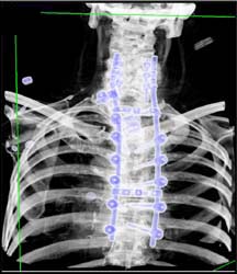 Post Spinal Fusion - CTisus CT Scan