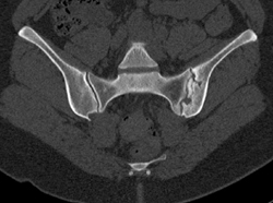 Sacroiliitis With Osteomyelitis - CTisus CT Scan