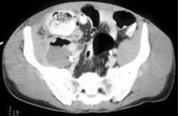 Psoas Abscess - CTisus CT Scan