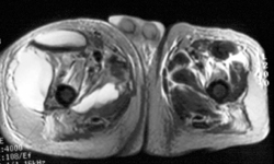 Tropical Myositis - CTisus CT Scan