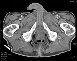 Necrotizing Fasciitis - CTisus CT Scan