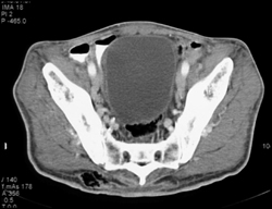 Necrotizing Fasciitis - CTisus CT Scan