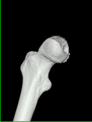 Pelvic Fracture With Disarticulation of the Femur - CTisus CT Scan