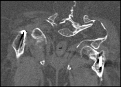 Osteogenesis Imperfecta - CTisus CT Scan