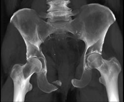 Acetabular Fracture and Symphysis Fracture - CTisus CT Scan