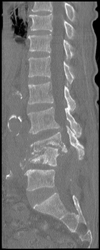 Osteomyelitis - CTisus CT Scan