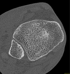 Calcaneal Fracture - CTisus CT Scan