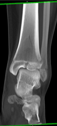 Spiral Fracture With Fracture Line Through Epiphysis - CTisus CT Scan
