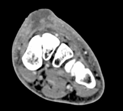 Abscess - CTisus CT Scan