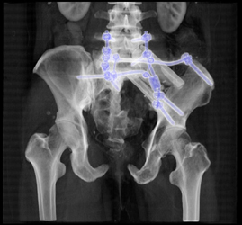 S/P Tumor Resection - CTisus CT Scan