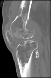 Pigmented Villonodular Synovitis (PVNS) - CTisus CT Scan