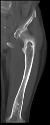 Exostosis - CTisus CT Scan
