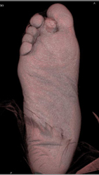 Chondroid Tumor - CTisus CT Scan