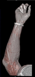 Cellulitis - CTisus CT Scan