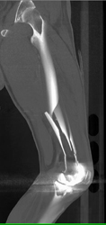 Femur Fracture - CTisus CT Scan