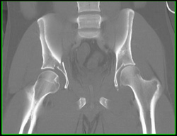 Acetabular Fracture - CTisus CT Scan