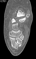 Talus Fracture - CTisus CT Scan