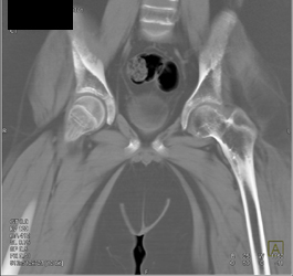 Normal Muscles of Pelvis - CTisus CT Scan