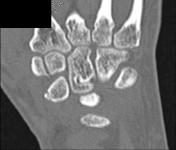 Old Fracture - CTisus CT Scan