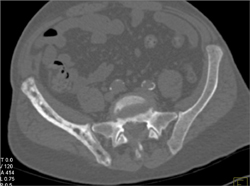 Blastic Metastases to the Iliac Bone Vs Paget's Disease- Paget's Is Diagnosis - CTisus CT Scan