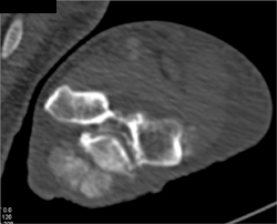 Gout - CTisus CT Scan