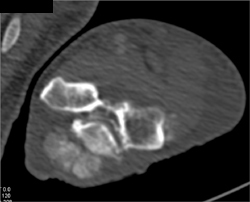 Gout - CTisus CT Scan