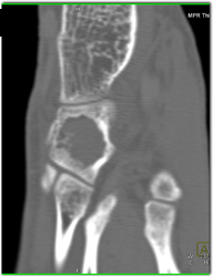 Bone Cyst With Fracture - CTisus CT Scan