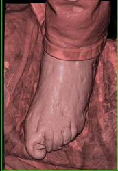 Exostosis Off First Digit - CTisus CT Scan
