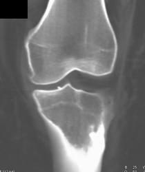 Joint Mouse - CTisus CT Scan