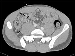 Prior Bone Resection - CTisus CT Scan