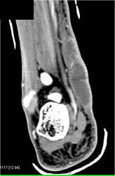 Abscess Ankle - CTisus CT Scan