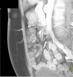 DIEP Flap Planning - CTisus CT Scan