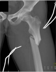 Femur Fracture - CTisus CT Scan