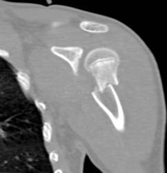 Humerus Fracture - CTisus CT Scan