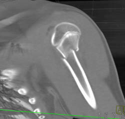Humerus Fracture - CTisus CT Scan