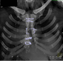 Nonunion Sternum With Fractured Wires - CTisus CT Scan