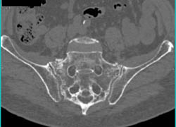 Stress Fracture Sacrum - CTisus CT Scan