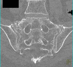 Stress Fracture Sacrum - CTisus CT Scan