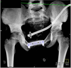 Repair of Exotrophy - CTisus CT Scan
