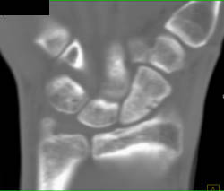 Subtle Talus Fracture - CTisus CT Scan