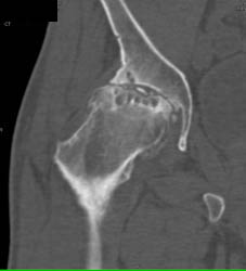 Avascular Necrosis (AVN) With Degenerative Joint Disease (DJD) - CTisus CT Scan