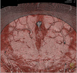 DIEP Flap Planning - CTisus CT Scan