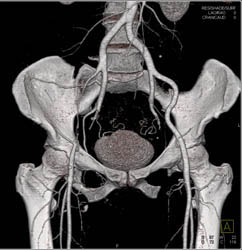 Occlusion of Right External Iliac Artery and Collaterals Best Appreciated With Bone Removal - CTisus CT Scan
