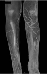 Cellulitis - CTisus CT Scan